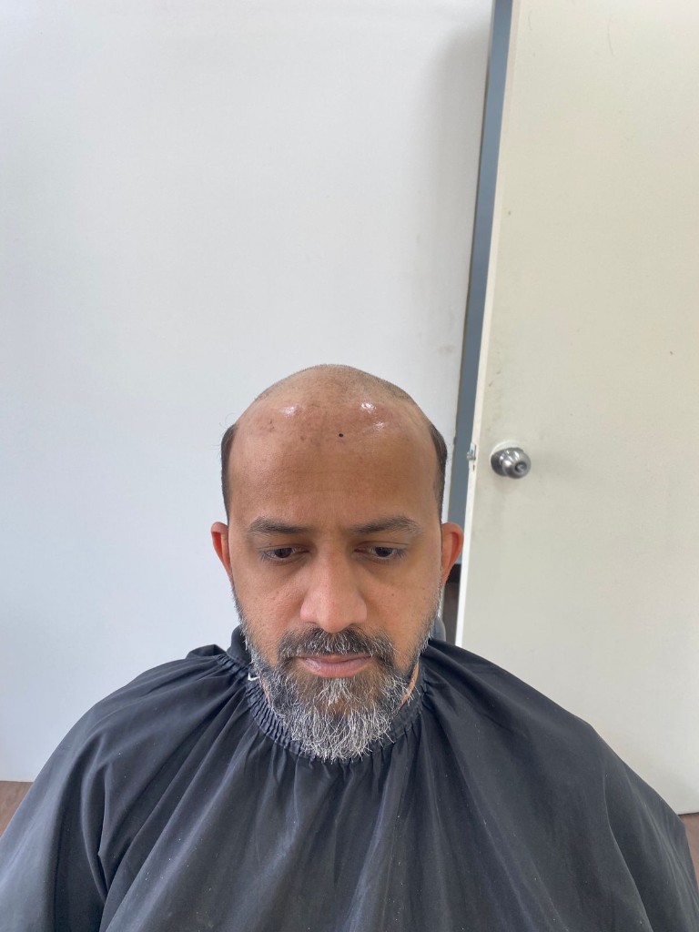Hair patch fitting and consultation