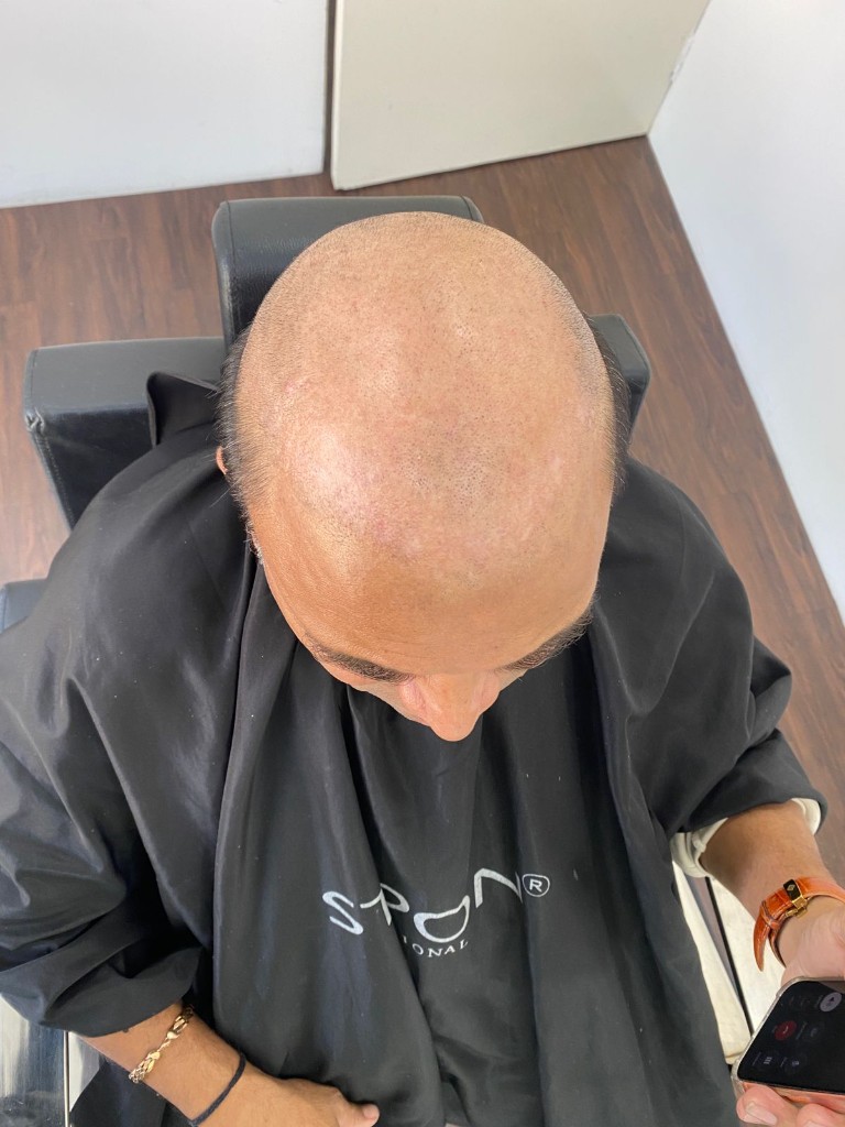Custom hair system design