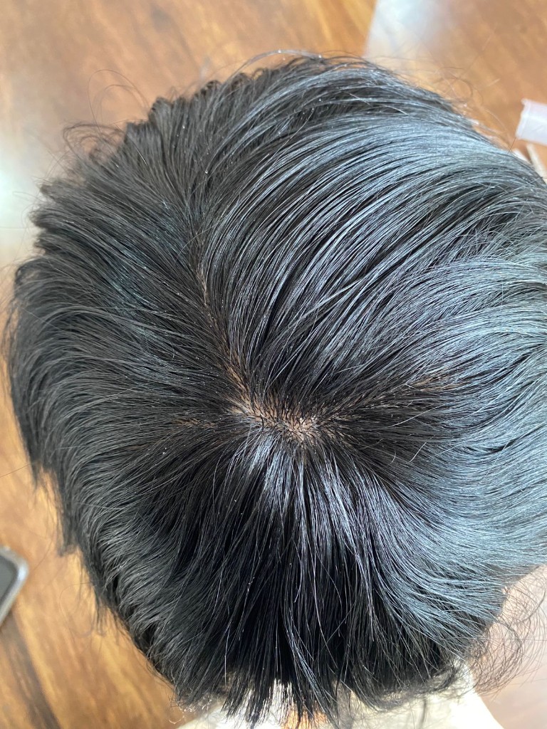 Natural hairline result